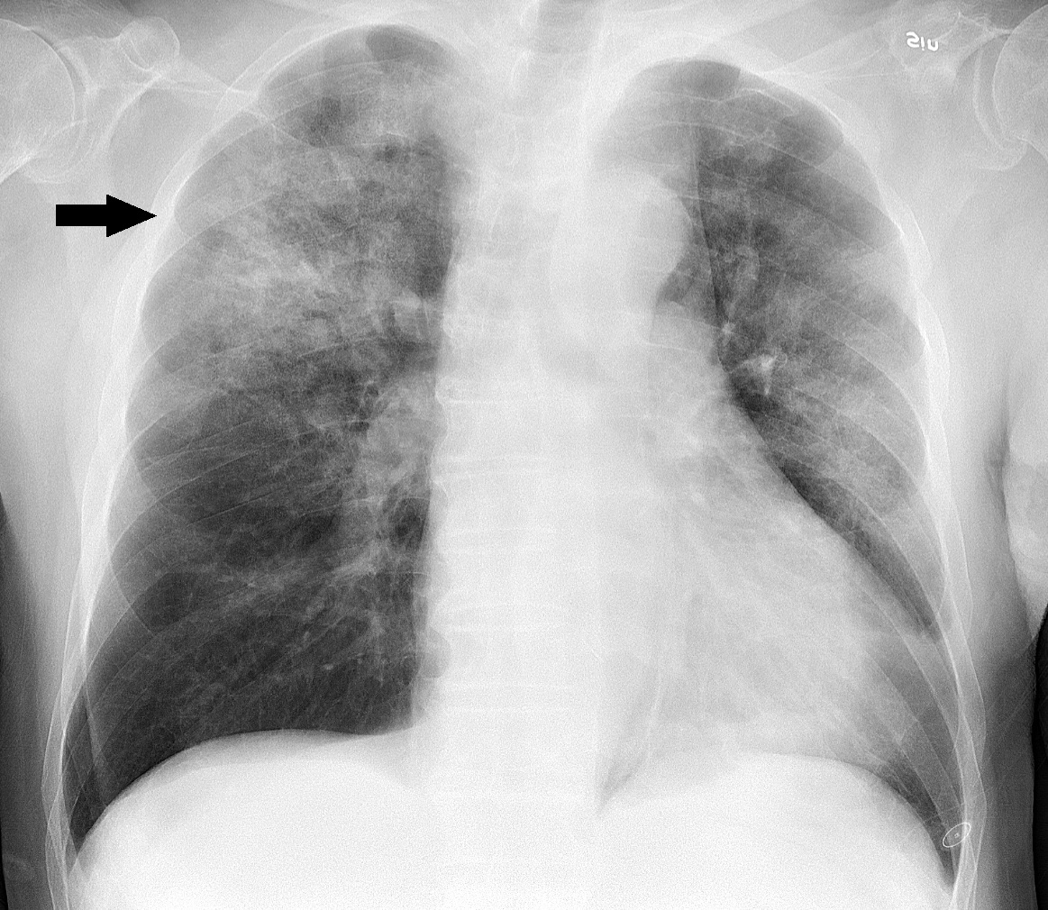 Pneumonia Detection
